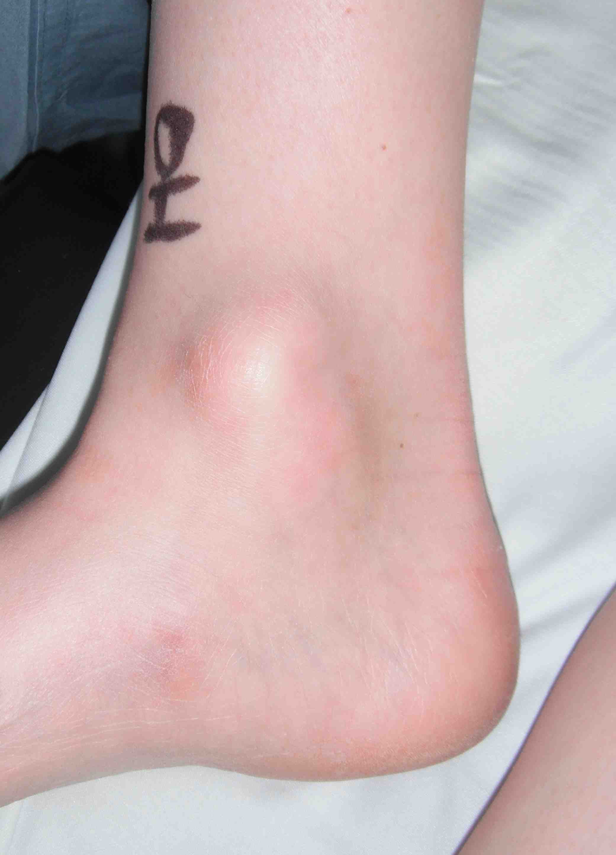 Ankle ganglion